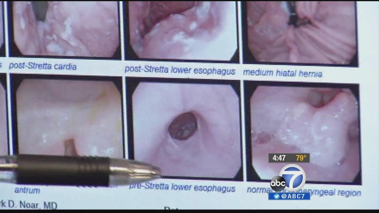 Stretta procedure alleviates pain from GERD | abc7.com