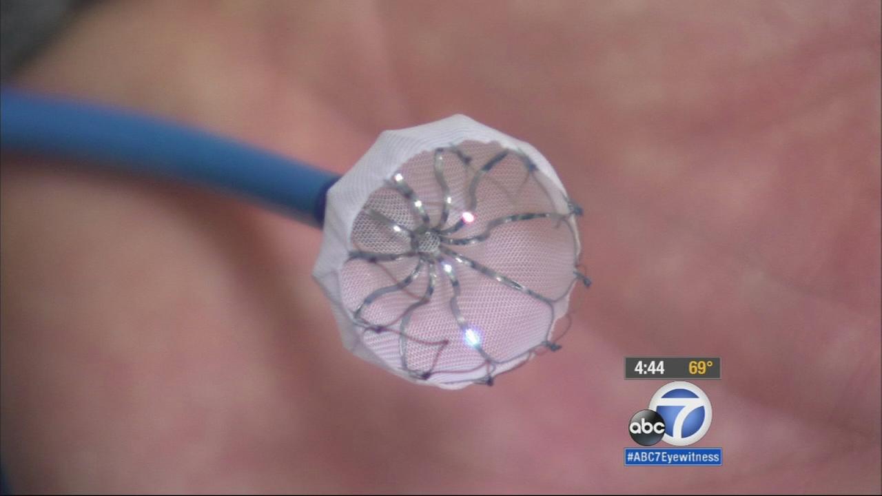 watchman-implant-can-reduce-risk-of-stroke-blood-clots-abc7