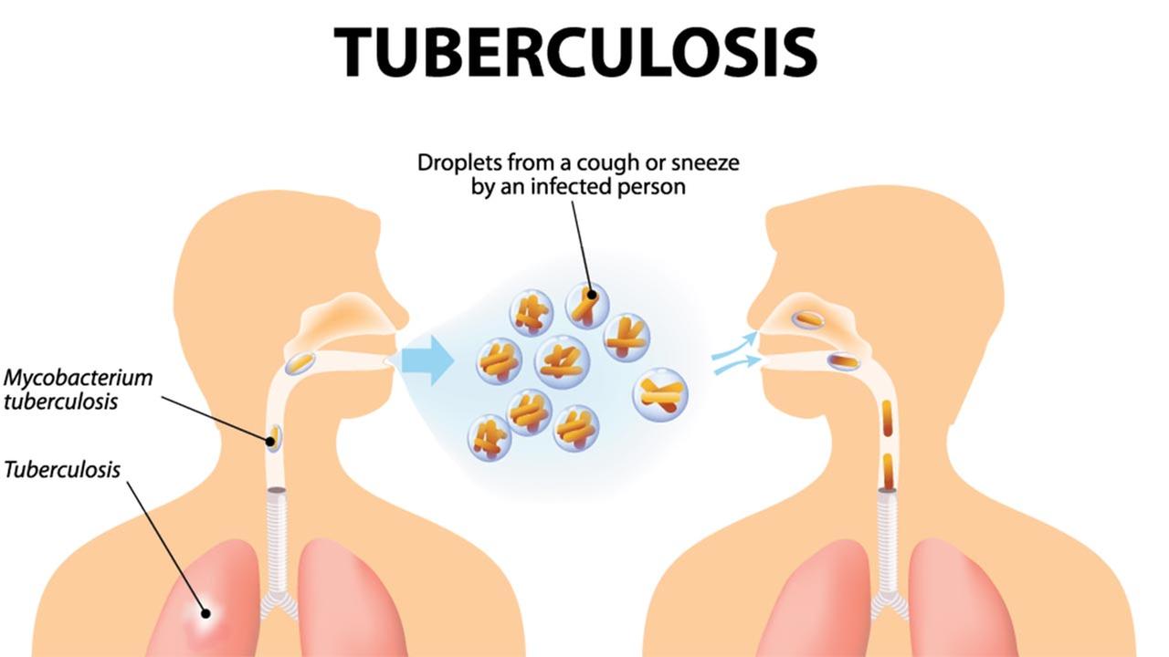 Bullard High student diagnosed with tuberculosis