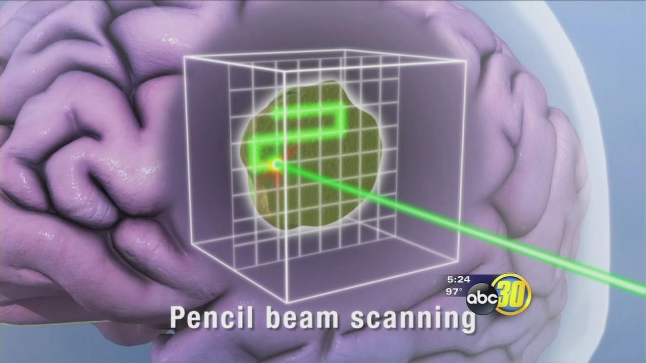 Pencil Beam Proton Therapy pencil beam protons zap cancer abc30 Pencil Beam Proton Therapy pencil beam protons zap cancer abc30