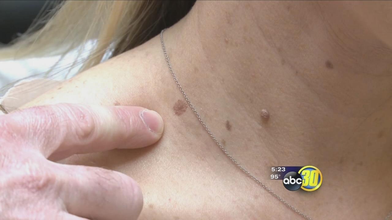 How to avoid skin cancer