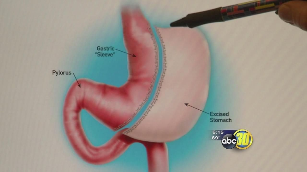 Weight loss surgery research paper