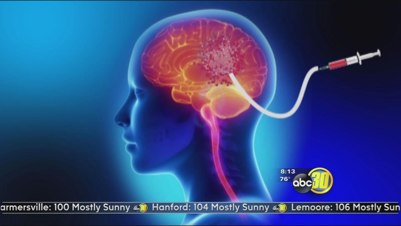 brain-tumor-cath-glioblastoma-gps-abc30