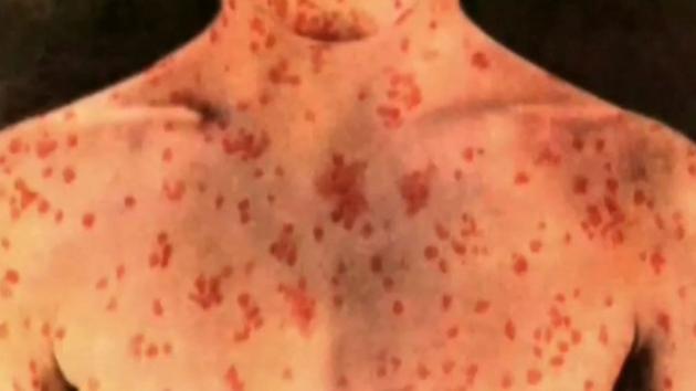 Doctors encourage vaccinating for measles in face of outbreak.