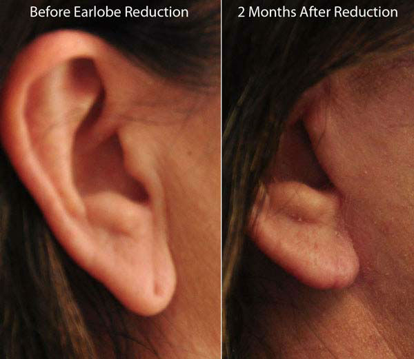 20 minute procedure can repair ripped earlobes