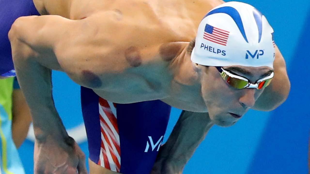 Cupping 101 Why Michael Phelps and other Olympians have bright red
