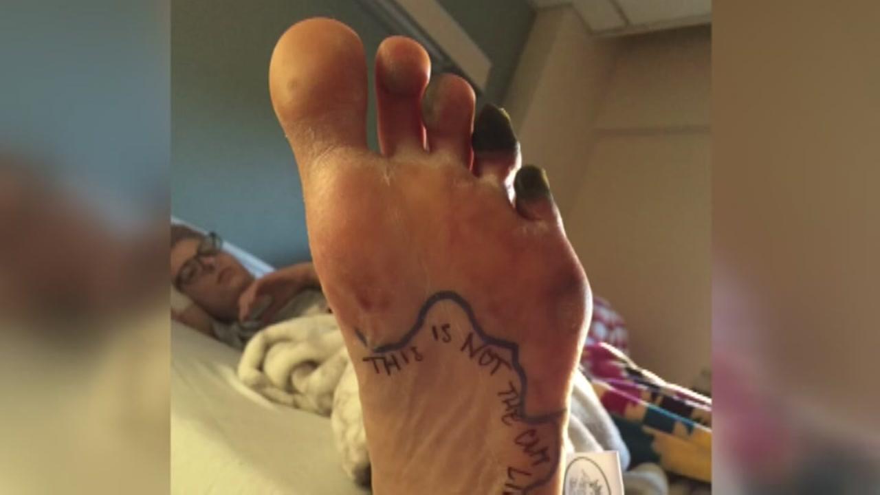 Woman loses fingers, toes to strep throat