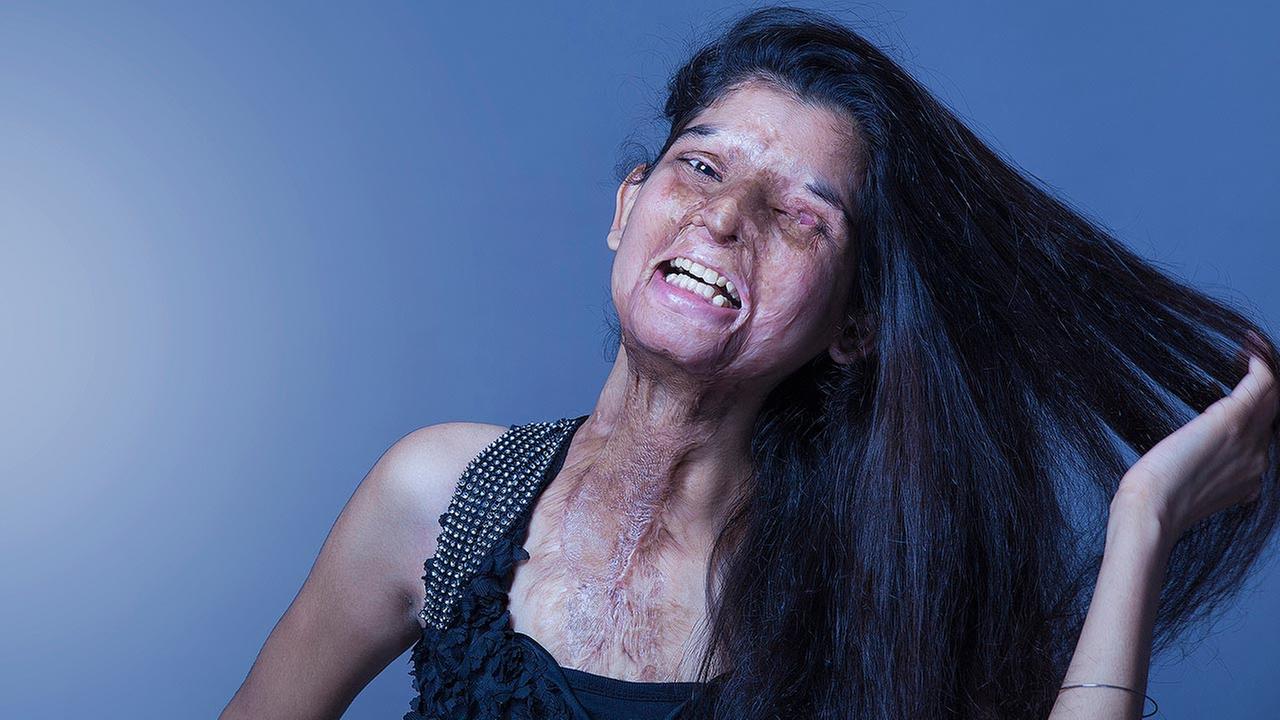 Acid Victims Photo Shoot Draws Attention In India