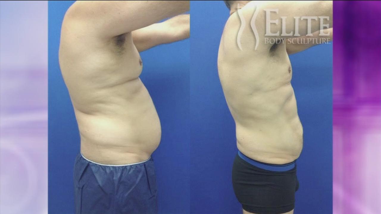 Lose weight on your lunch break with new lipo