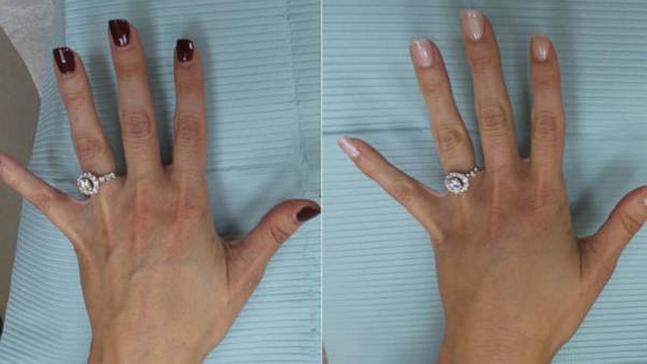 Woman Turns To Plastic Surgery To Make Hands Selfie Worthy For