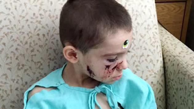 4-year-old boy attacked by pit bull on Staten Island