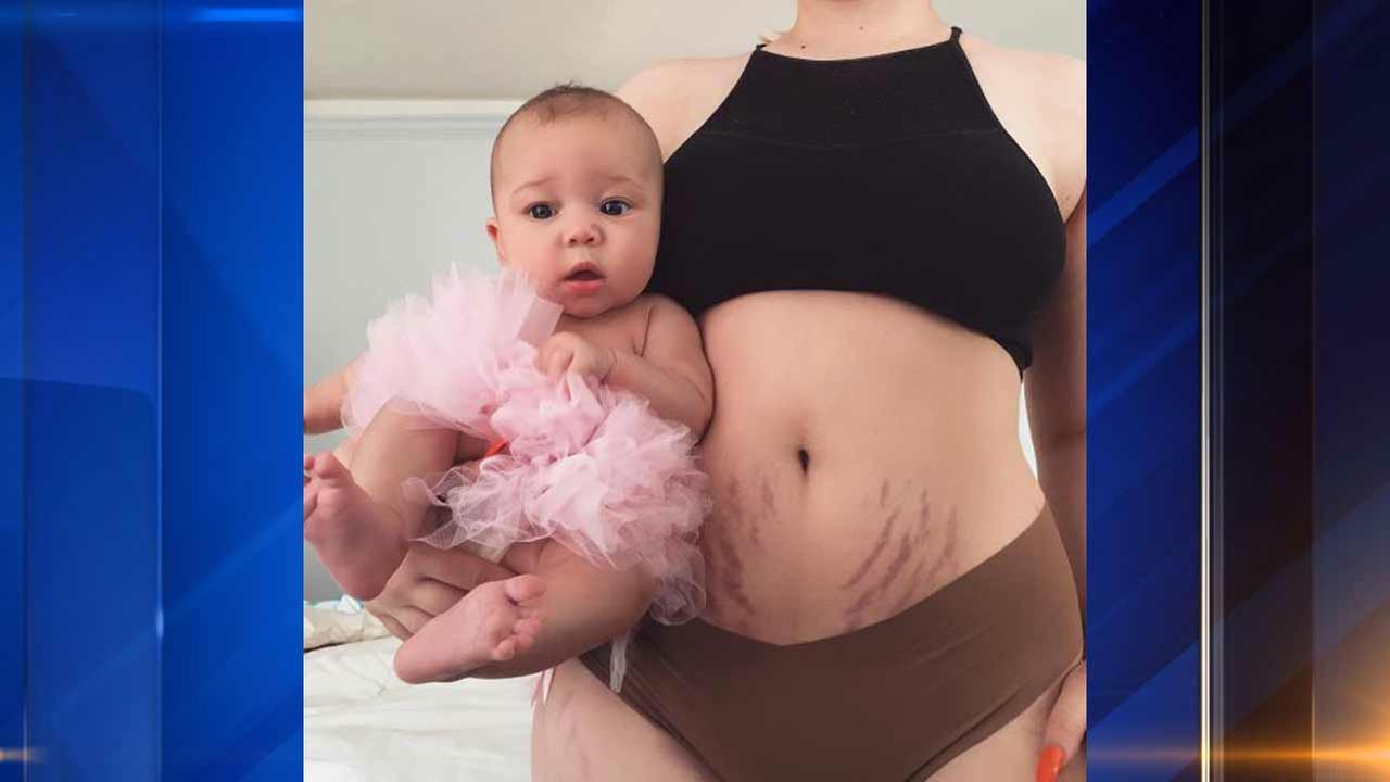 New mom pens tribute to her stretch marks: 'I earned my stripes' - abc7chicago.comNew mom on stretch marks: 'I earned my stripes' - _