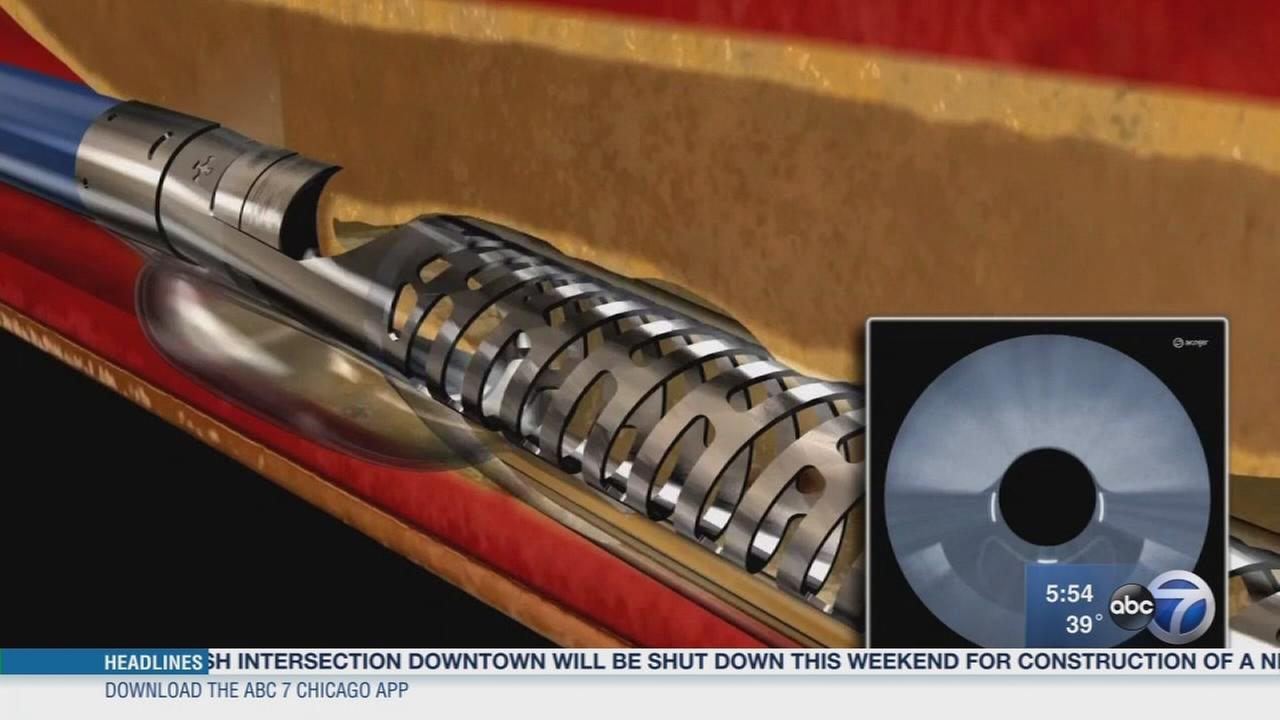New technology helps unclog leg arteries - WLS-TV