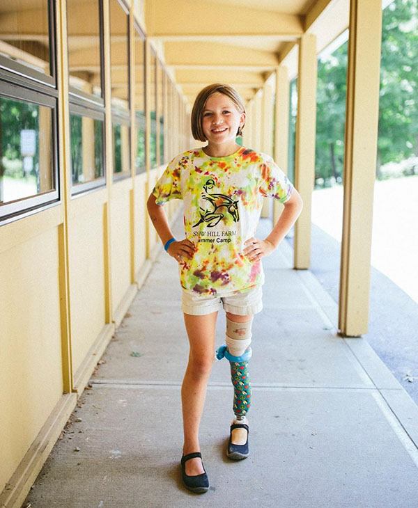 Young amputee's love for life will inspire you