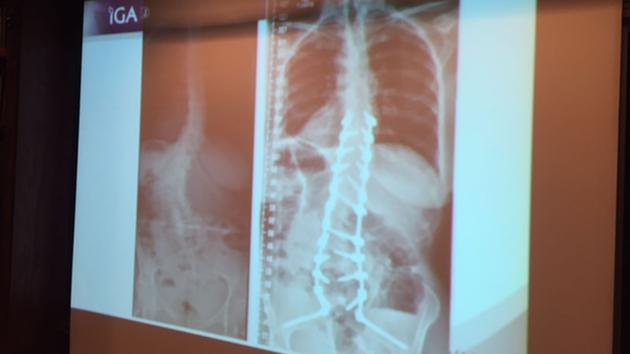 X-ray of Stephanie's spine before surgery