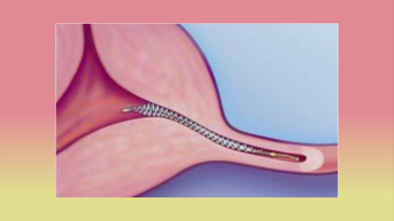 ITeam Side effect claims made about popular birth control drug Essure