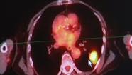 A new form of radiation therapy holds the promise of longer life for people battling lung cancer.