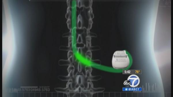 Electric device helps treat chronic back pain