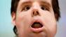 Oscar, a man who underwent a full-face transplant in April, poses for the photographers as he appears in public for the first time in a news conference at the Vall dHebron Hospital in Barcelona, Spain, Monday, July 26, 2010.