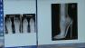 An X-ray compares feet with high heels on and feet without high heels.