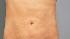 Final Inches touts laser liposculpture