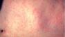 The Centers for Disease Control and Prevention says 2011 was the worst year for the virus in 15 years in the U.S.