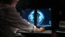 An X-ray image used for a mammogram screening is seen in this file photo.