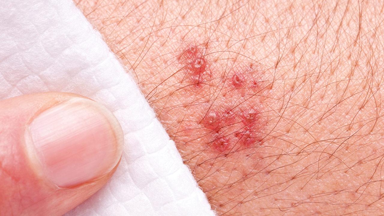 Does Shingles Cause A Weakened Immune System