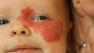 A baby is seen with a hemangioma, a benign tumor.