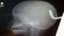 A 17-month-old boys family is calling him a miracle baby  after he survived an accident that landed him impaled head-first on a metal hook.