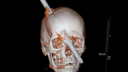 This tomography scan released Thursday, Aug. 16, 2012 by the Miguel Couto hospital, shows the skull of 24-year-old construction worker Eduardo Leite pierced by a metal bar in Rio de Janeiro, Brazil. Doctors say Leite survived after a 6-foot metal bar fell from above him and pierced his head. Luiz Essinger of Rio de Janeiros Miguel Couto Hospital Friday told the Globo TV network that doctors successfully withdrew the iron bar during a five-hour-long surgery. (AP Photo/Miguel Couto Hospital)