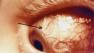 Ashley Hyde nearly goes blind from eye-eating parasite on contact lens