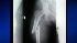 There are reports that in some women, over time, some osteoporosis drugs weaken certain bones.