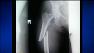 There are reports that in some women, over time, some osteoporosis drugs weaken certain bones.