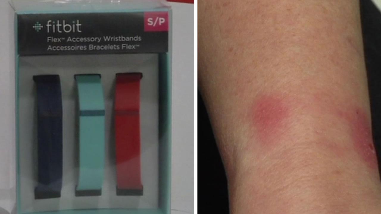 rash from fitbit band