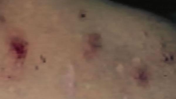 Morgellons Disease
