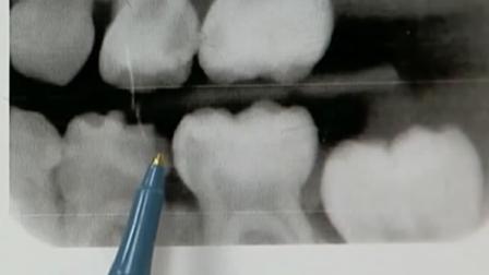 Sweets arent the only thing causing cavities