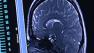 New brain images could improve PTSD treatments
