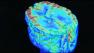Alzheimers brain