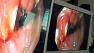 Doctor looks inside a patients esophagus