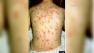 SFSU health officials send chicken pox warning