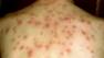 Third case of chicken pox reported at SFSU