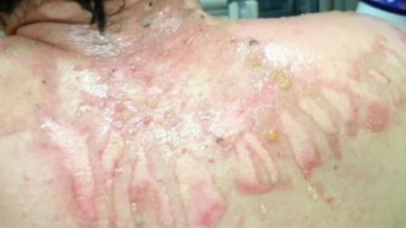 sunscreen burns