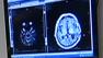 X-ray of brain