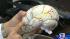 Medical advances help brain injury patients... ::