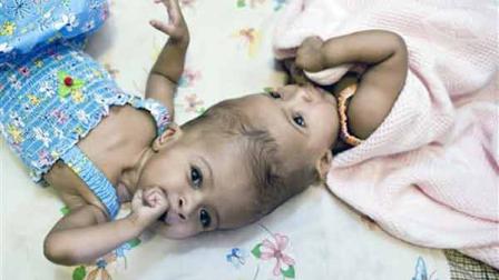 Undated handout photo released Sunday Sept.18, 2011 by British charity Facing the World of conjoined twins Rital and Ritag Gaboura (left to right not given) before they were successfully separated at Londons Great Ormond Street Hospital for Children. Facing the World says Rital and Ritag Gaboura were born in Sudan with the tops of their heads stuck together. Twins born joined at the head _ known as craniopagus twins _ occur in about one in 2.5 million births and successful attempts to split them are rare. However, the condition can lead to serious medical problems and the charity said the twins parents asked for help funding surgery to pull the two apart. The charity said Sunday the two were finally separated last month and appear to be healthy. (AP Photo / Facing the World, ho)