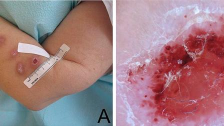 Morgellons lesions