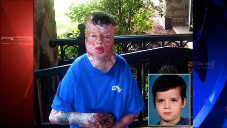 Robert Middleton, burned as an eight-year-old in 1998 died 12 years later in 2011 of cancer doctors attributed to his burn injuries