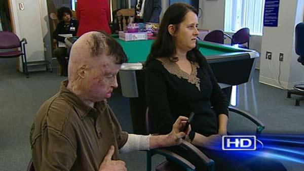 Robert Middleton continues to get treatment for his burns but keeps a positive attitude.