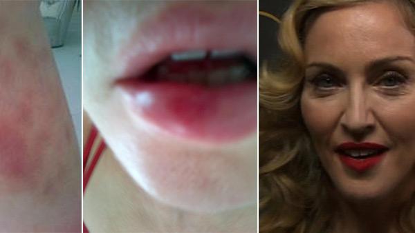 Madonna posted on March 10, 2012 these photos of what she says are bruises she sustained during rehearsals for her 2012 world tour. / Madonna appears backstage at the taping of Oprah Winfreys farewell show in Chicago on May 17, 2011. - Provided courtesy of facebook.com/media/set/?seta.10150730338184402.460112.10584534401&type1 / WLS Madonna posted on March 10, 2012 these photos of what she says are bruises she sustained during rehearsals for her 2012 world tour. / Madonna appears backstage at the taping of Oprah Winfreys farewell show in Chicago on May 17, 2011. - Provided courtesy of facebook.com/media/set/?seta.10150730338184402.460112.10584534401&type1 / WLS
